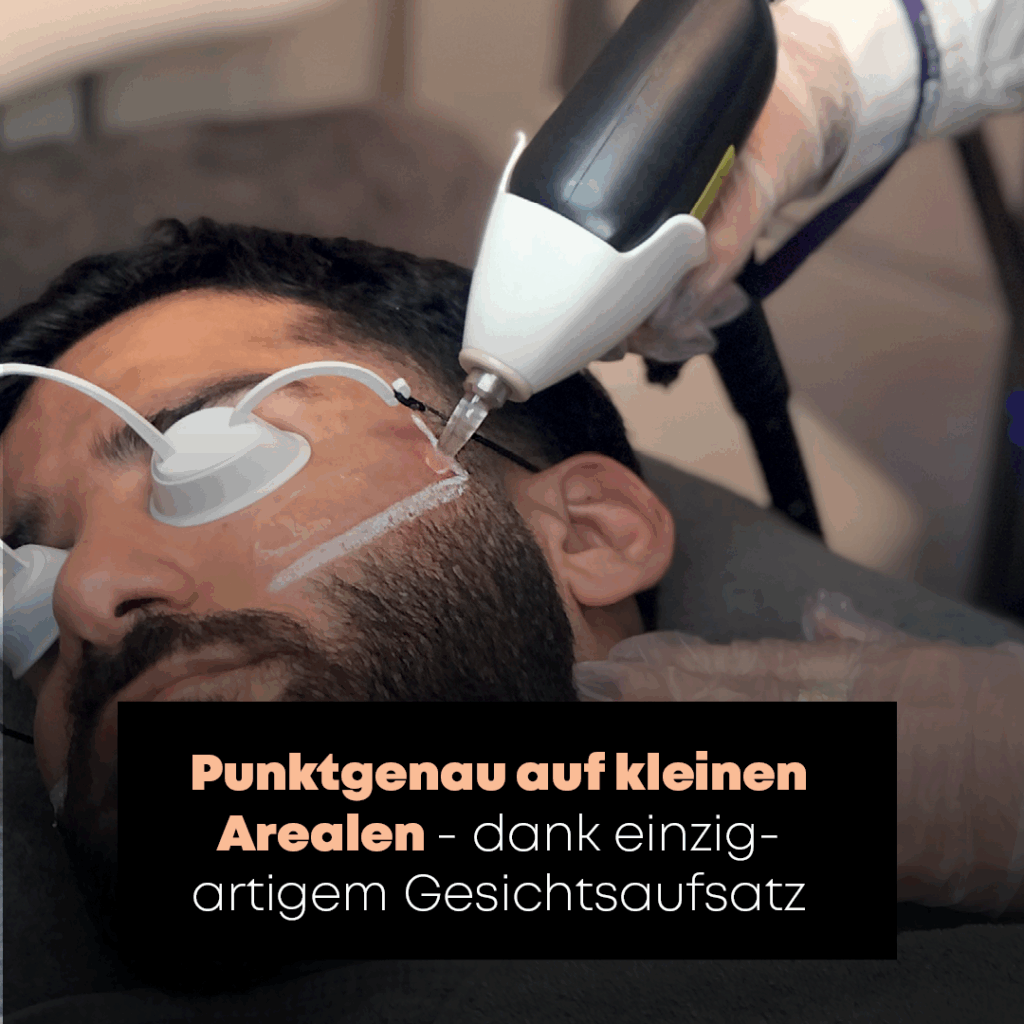 Laser Haarentfernung Mann