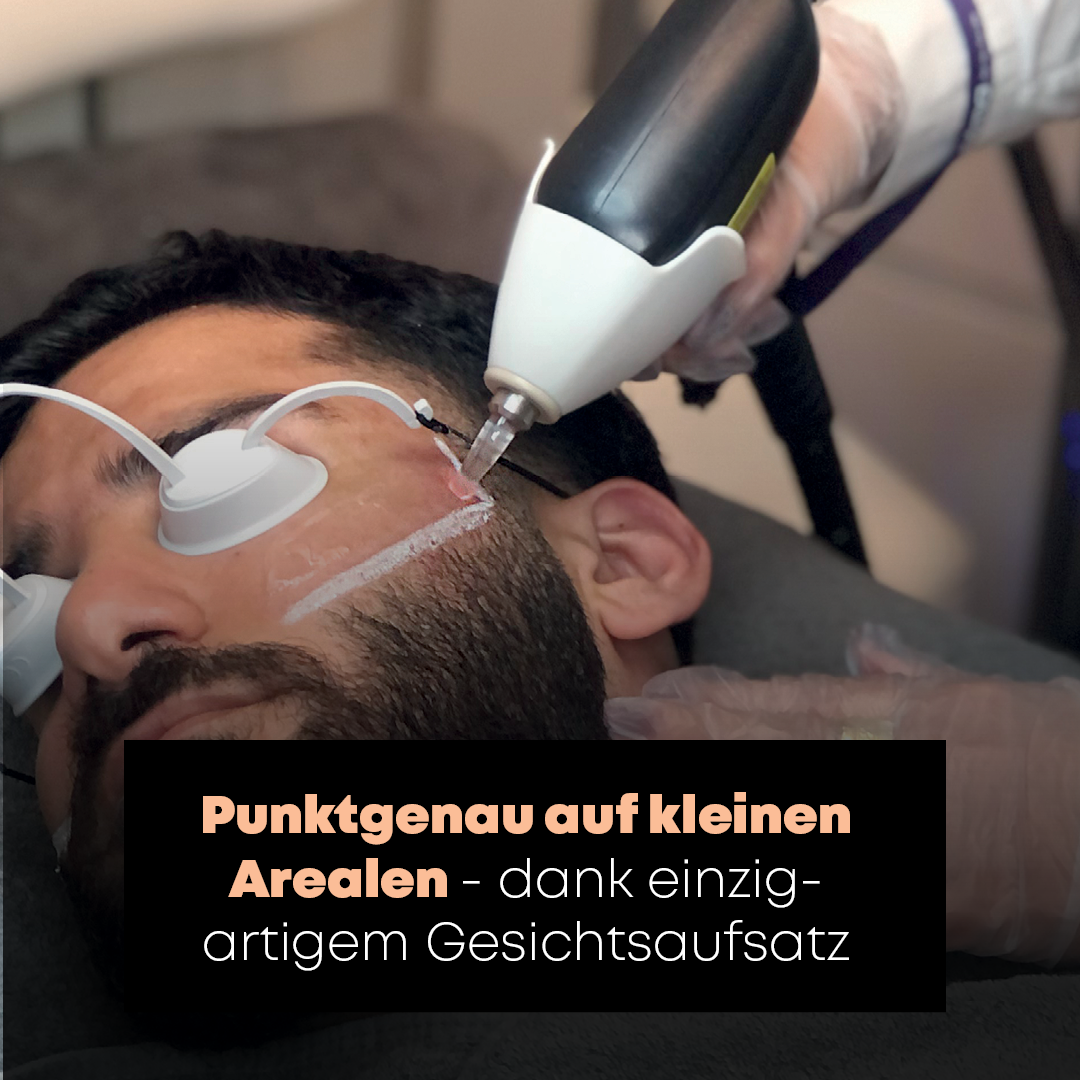 Laser Haarentfernung Mann